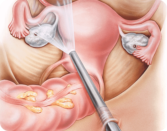 Laparoscopy testiing on women uterrus at Banker IVF