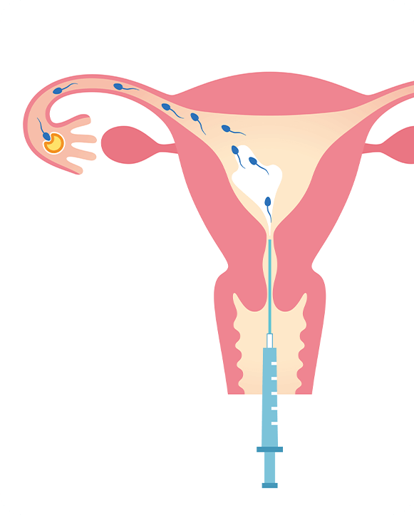 IUI Treatment Process