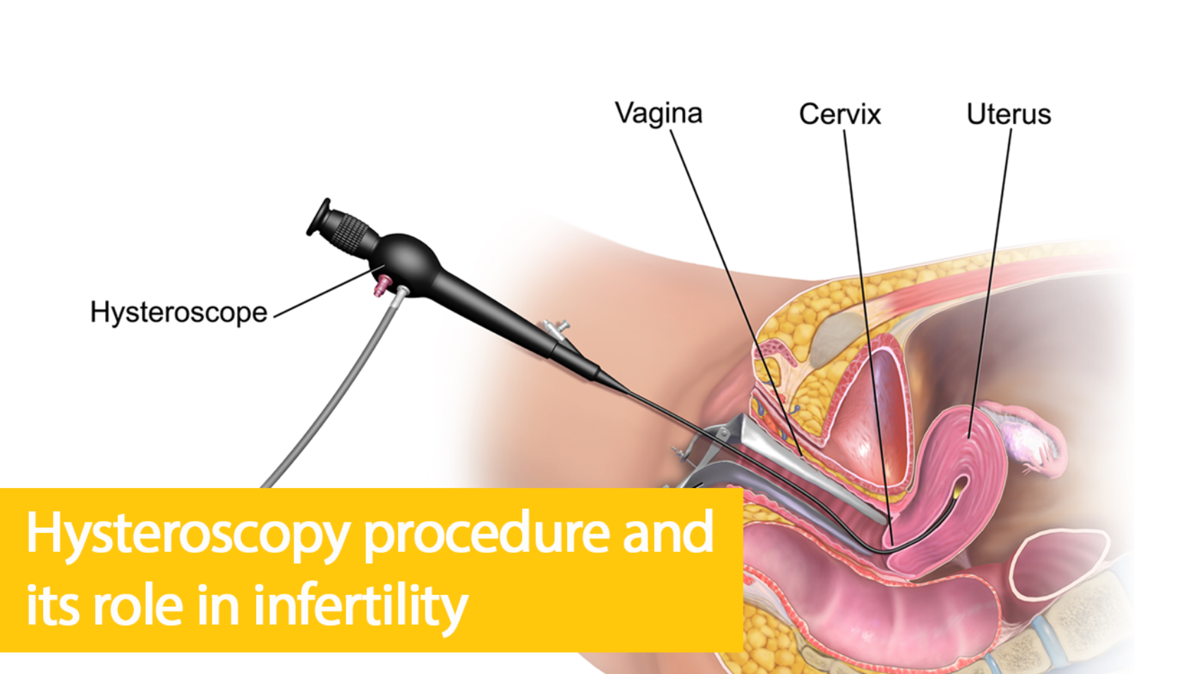 Hysteroscopy Procedure