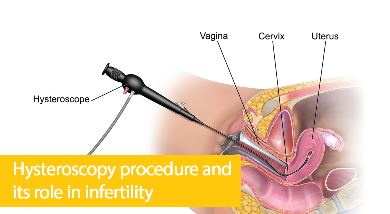 Hysteroscopy Procedure