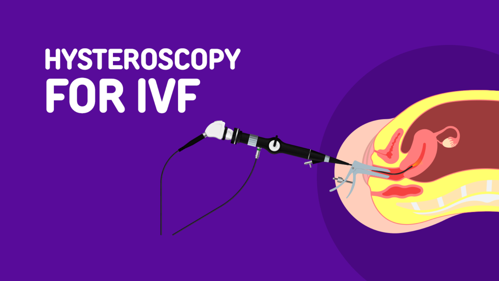Hysteroscopy for IVF